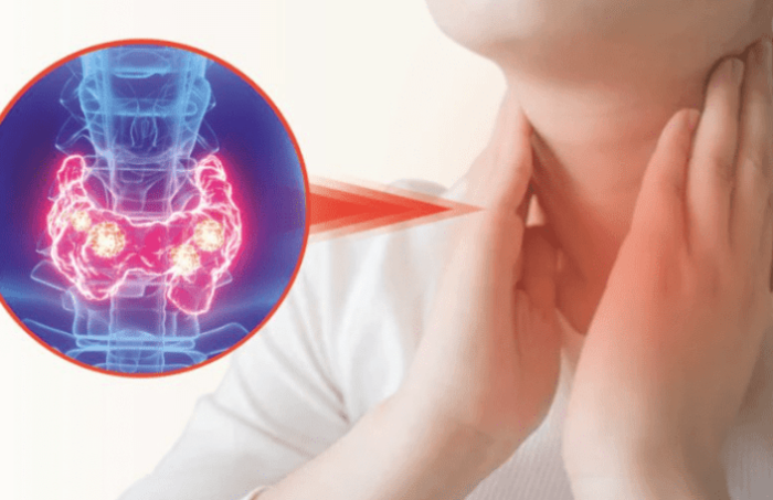 甲狀腺結節治療,甲狀腺結節本信息,治療方法,中醫治療,西醫治療,毛注意事項