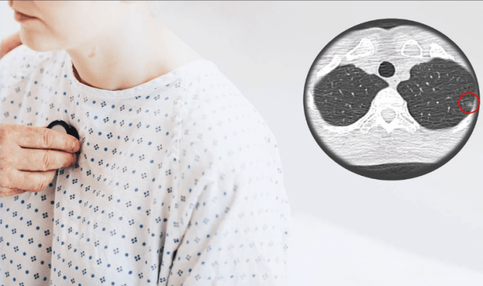 毛玻璃結節,毛玻璃結節前兆,毛玻璃結節原因,毛玻璃結節症狀,治療,飲食,預防,禁忌