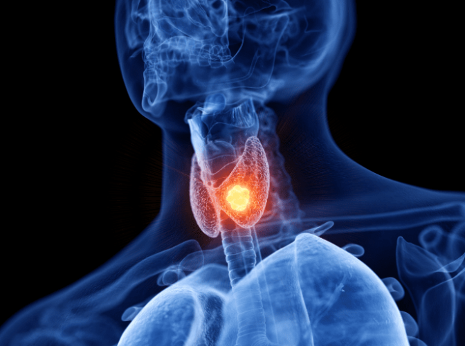 甲狀腺結節,甲狀腺結節前兆,甲狀腺結節原因,甲狀腺結節症狀,治療,飲食,預防,禁忌