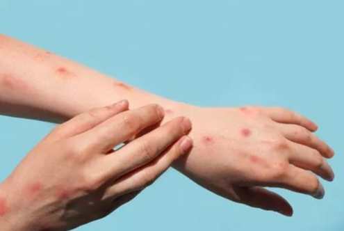 結節性癢疹全攻略：致病原因與最新治療對策