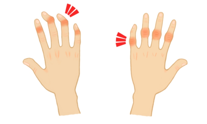 手指關節結節:常見原因與專業治療指南