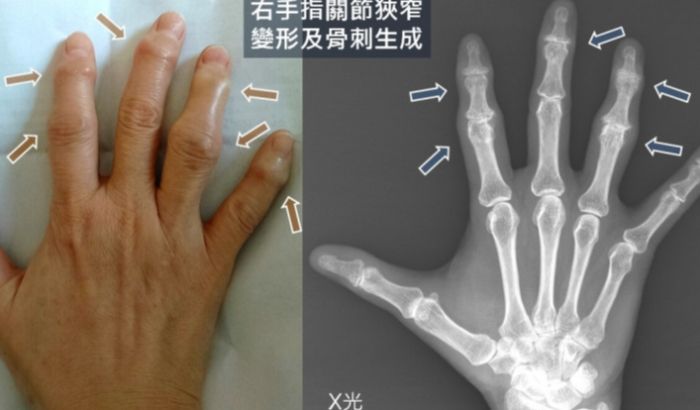 手指關節結節治療 手指關節結節治療