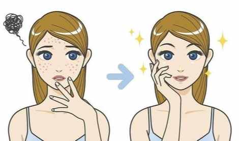 結節型痘痘：原因解析、治療方法與藥膏推薦全指南