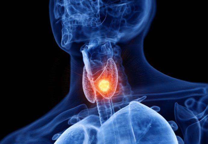 甲狀腺結節鈣化症狀 甲狀腺結節鈣化症狀