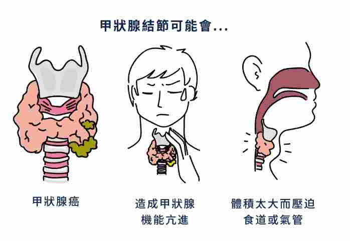 甲狀腺結節鈣化原因 甲狀腺結節鈣化原因