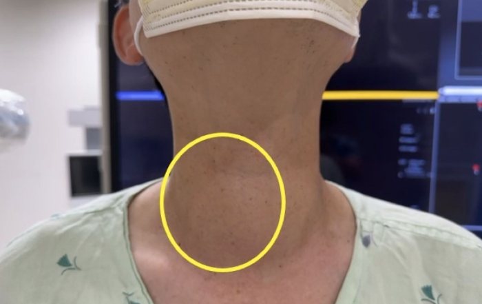 甲狀腺結節腫中醫 甲狀腺結節腫中醫