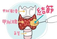 甲狀腺結節腫飲食