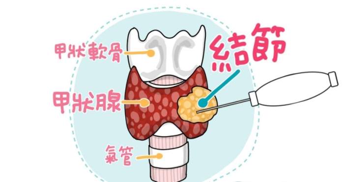 甲狀腺結節腫飲食治療 甲狀腺結節腫飲食治療