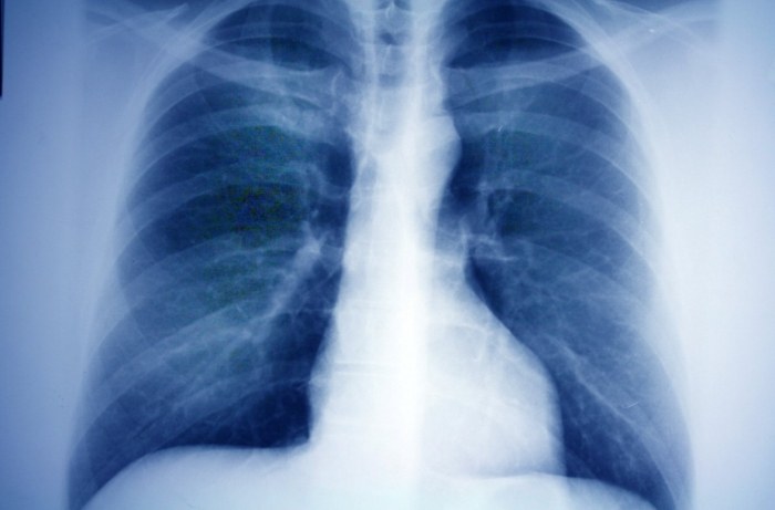 肺結節完全解析：從原因症狀到治療手術，一次搞懂肺結節知識與手術後遺症全攻略