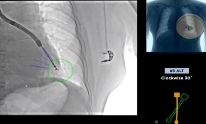 肺部毛玻璃樣結節需開刀嗎？關鍵症狀與手術時機完整解析