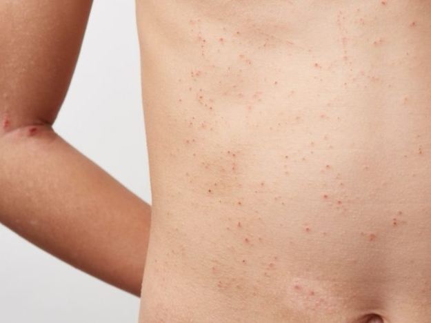 結節性硬化症：從致病機轉到全方位照護指南