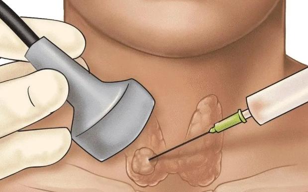 甲狀腺結節手術休息時間